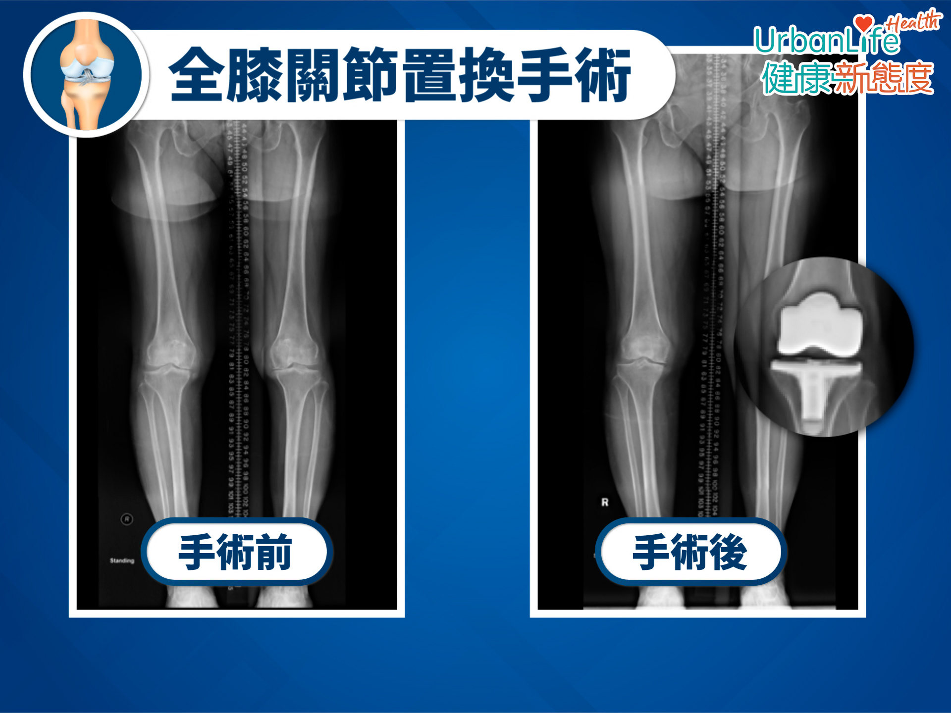 大概8成病人做完手術都會滿意全膝置換手術的效果。