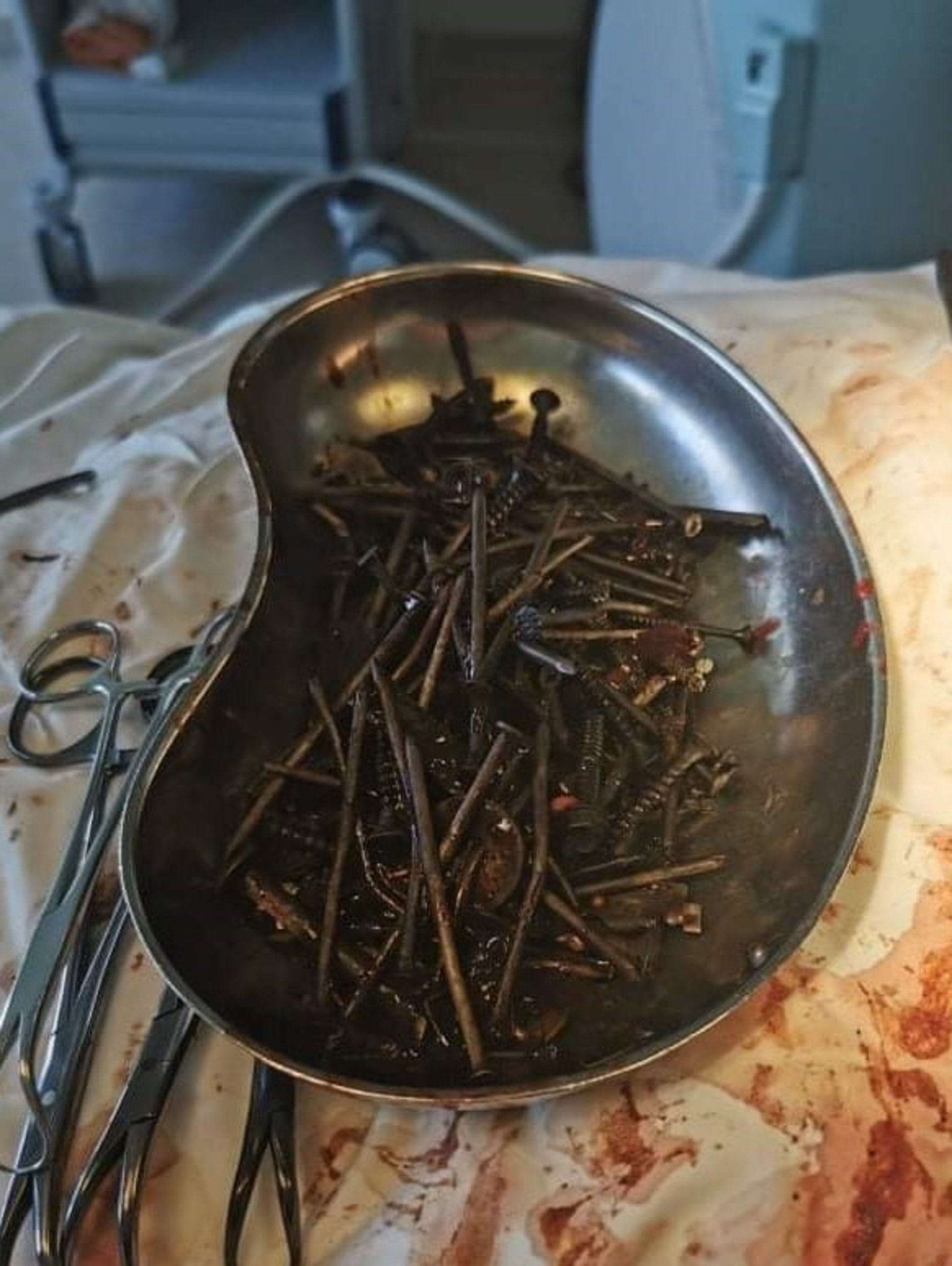 最終醫生從男子胃裡共取出高達1公斤以上的金屬物品。