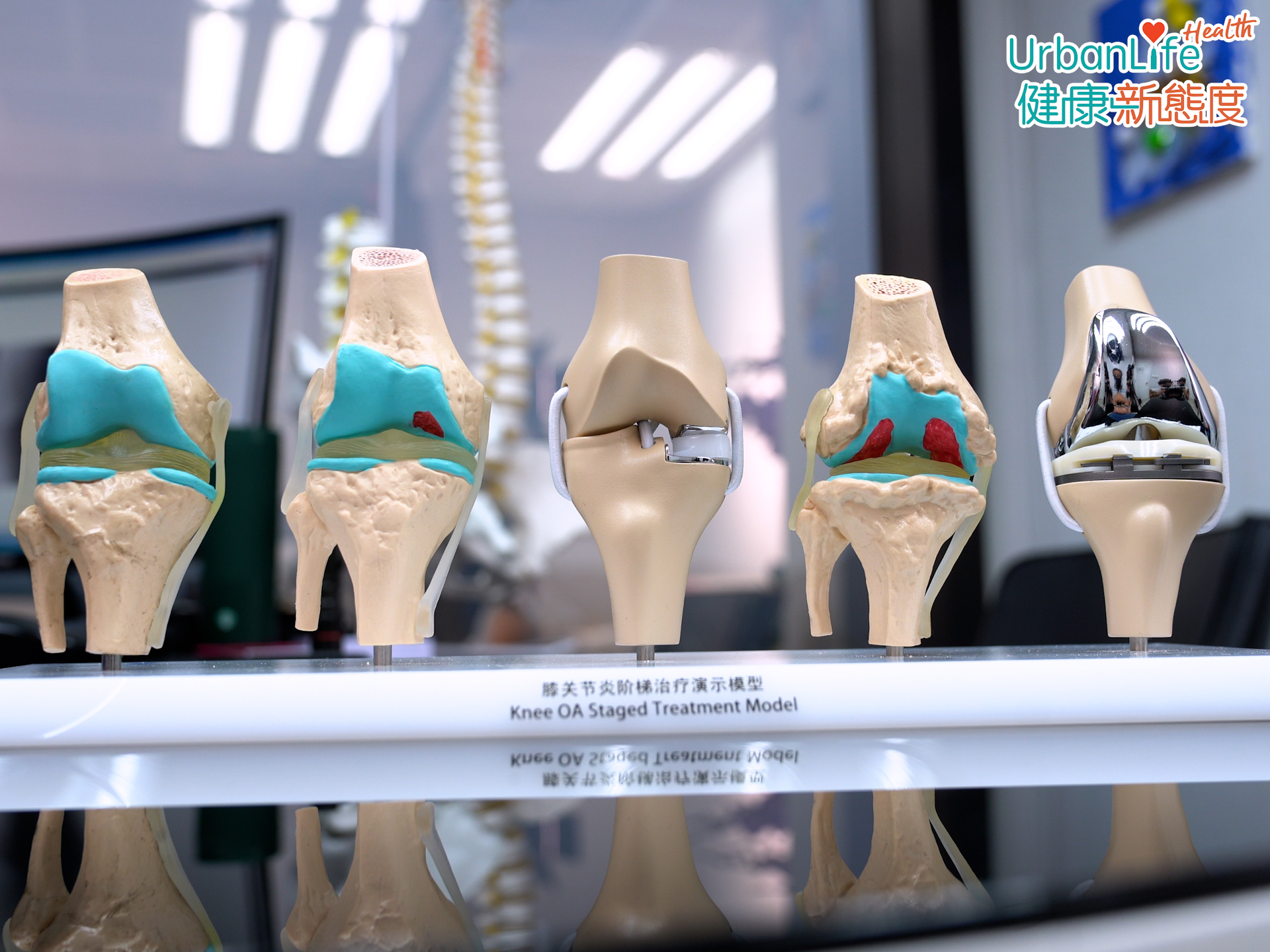 膝關節退化患者可根據病況,考慮不同的治療方案。