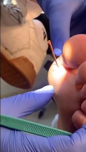 男子腳掌擠出2.5cm超長木刺,畫面嚇人。