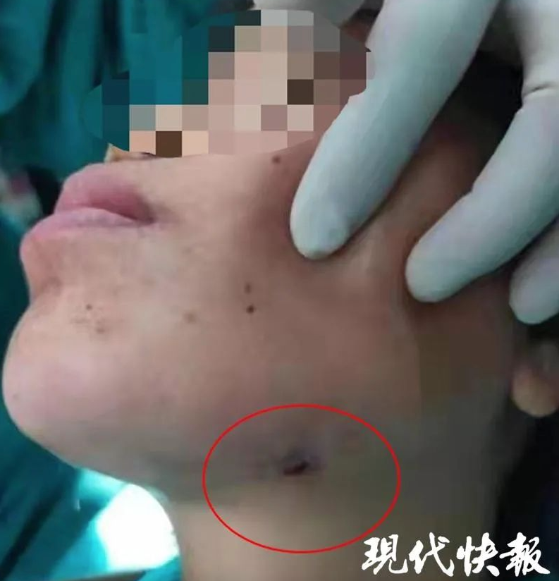 內地一名女子智慧齒持續發炎好幾年,只靠吃藥沒求醫。