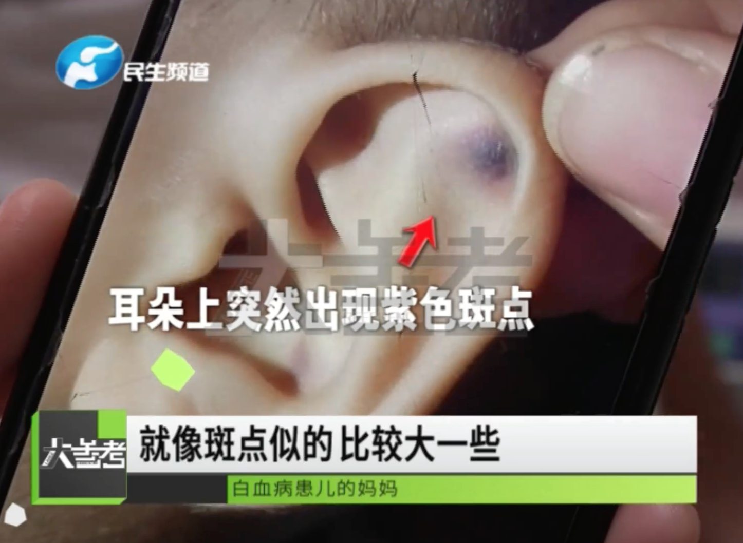 內地一名1歲男童出現反復發燒,而且耳朵突然出現紫色斑點。