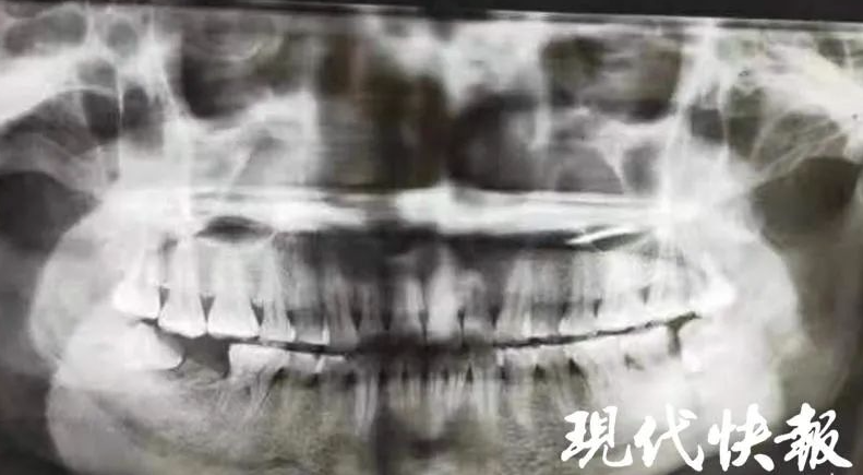 女子平時不注重口腔衛生,出現智慧齒冠周炎。