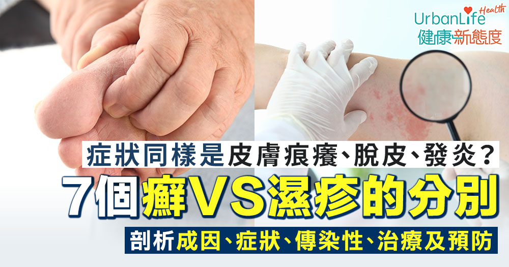 【癬VS濕疹】同樣是皮膚痕癢、脫皮?一圖了解7個濕疹和癬的分別 | UrbanLife 健康新態度