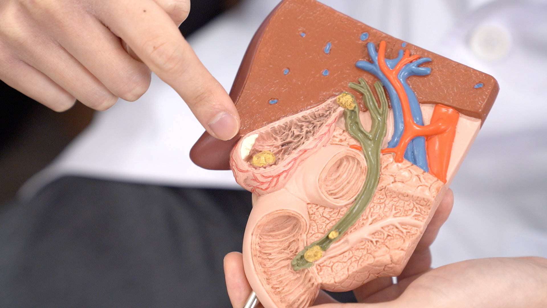 長期不進食，膽囊中的膽汁不會排出來，它會一直濃縮，有機會產生結晶片，一直繼續濃縮，可以形成膽石。