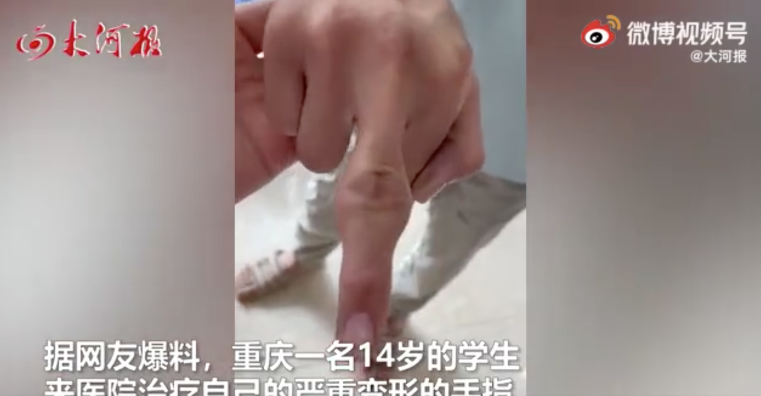 男生手指關節嚴重變形紅腫似「湯丸」。