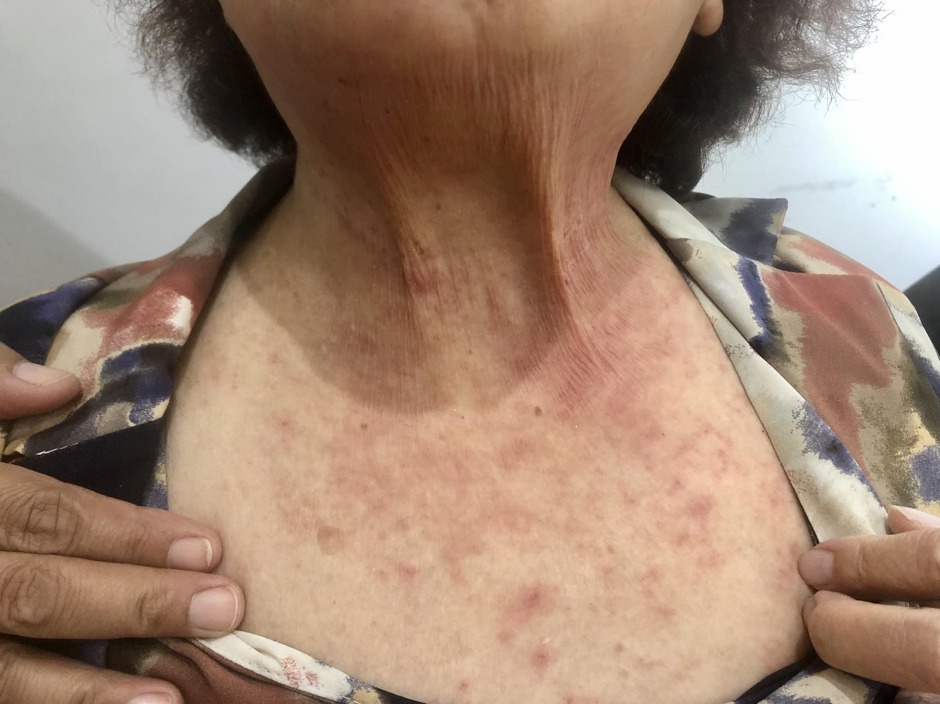 一名80歲婆婆食2隻蟹腳後濕疹急性發作,皮膚又痕又紅。
