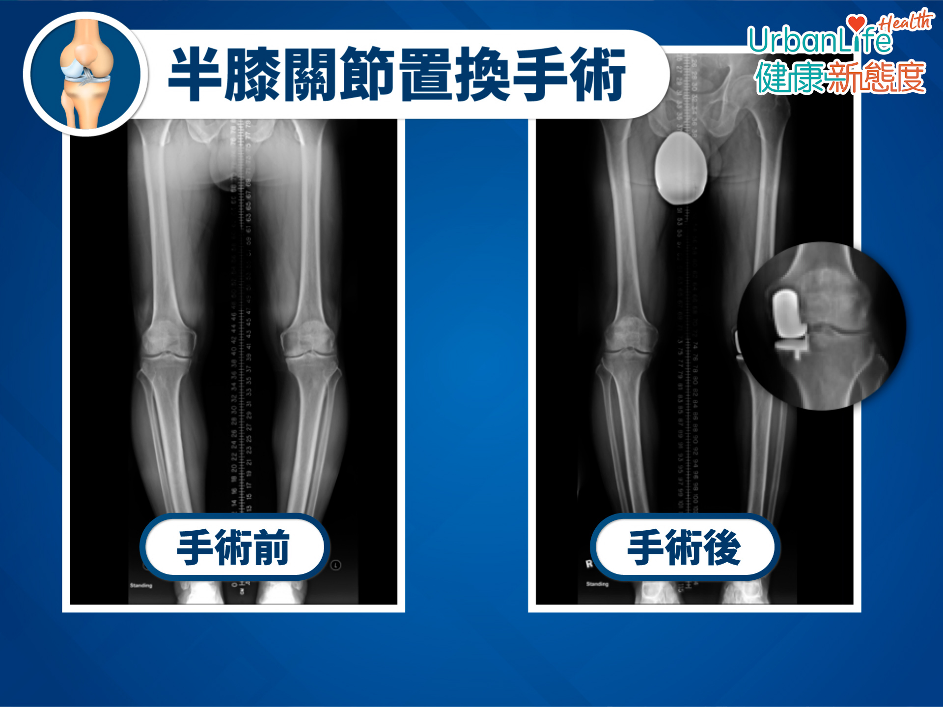 若病人只是部分關節有退化問題,可考慮半膝關節置換手術。