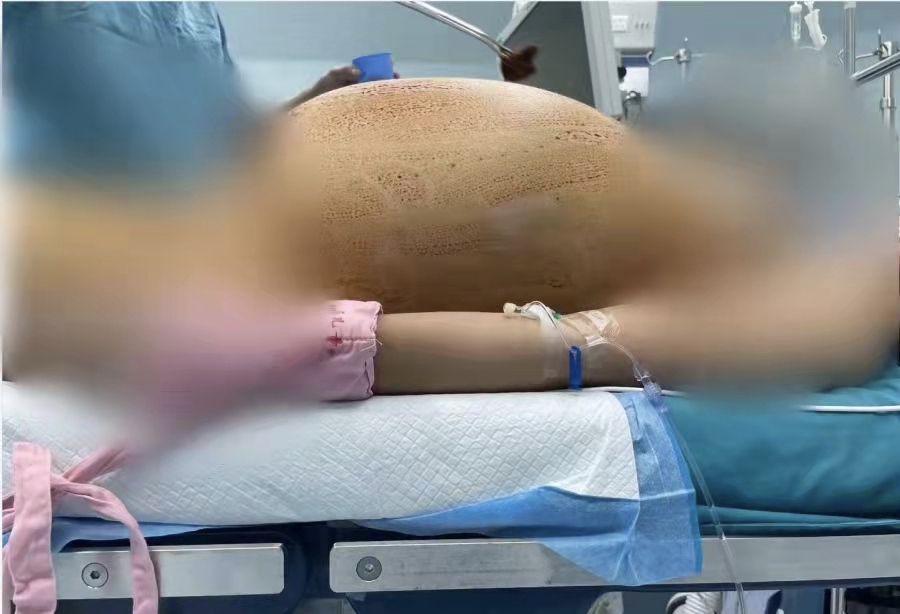 深圳一名13歲女童體重急增約66磅,腹脹有如十月懷胎。