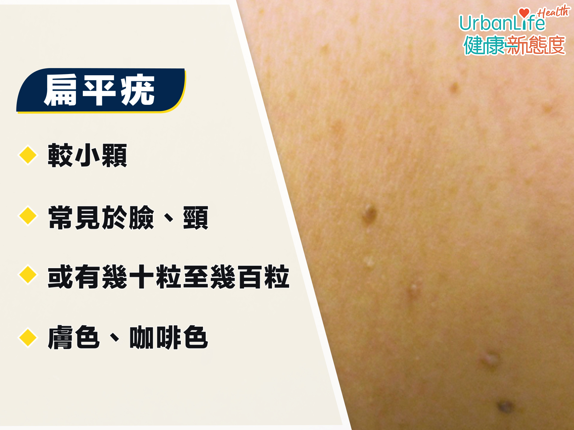 扁平疣一般較小顆如芝麻般。