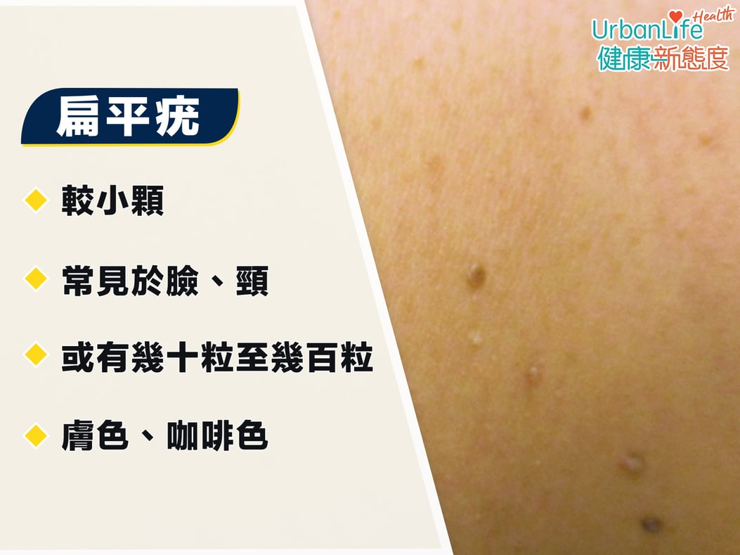 【疣的種類】扁平疣、尋常疣有什麼分別? 了解皮膚疣成因及治療