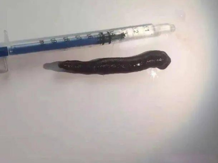 醫生在男童鼻中取出了一隻約5厘米長的吸血水蛭。