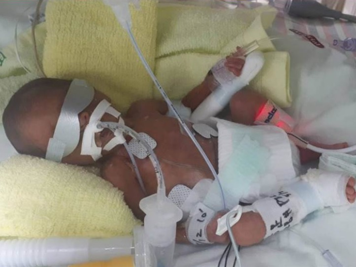 在25週4天時剖腹產出體重830公克(約1.8磅)的細女。