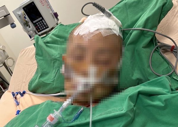 送院後醫生發現婦人腦出血,需進行緊急開顱手術,但術後她仍陷入重度昏迷。