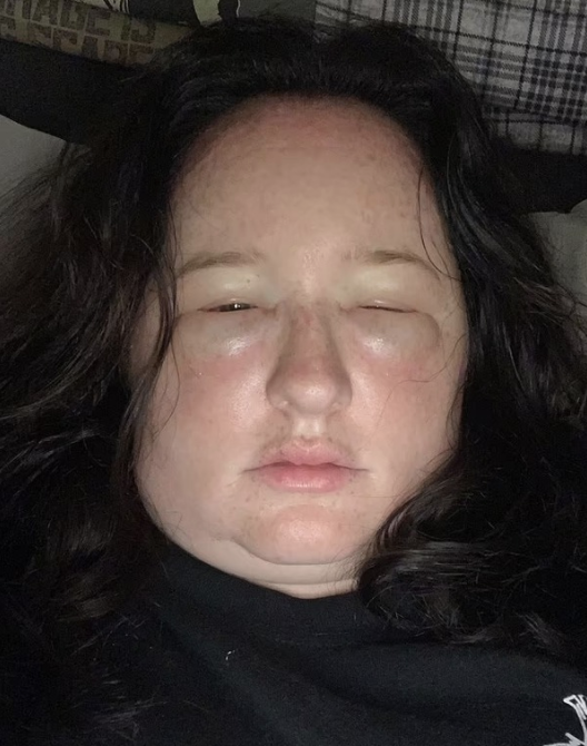 求醫證患「延遲性過敏反應」