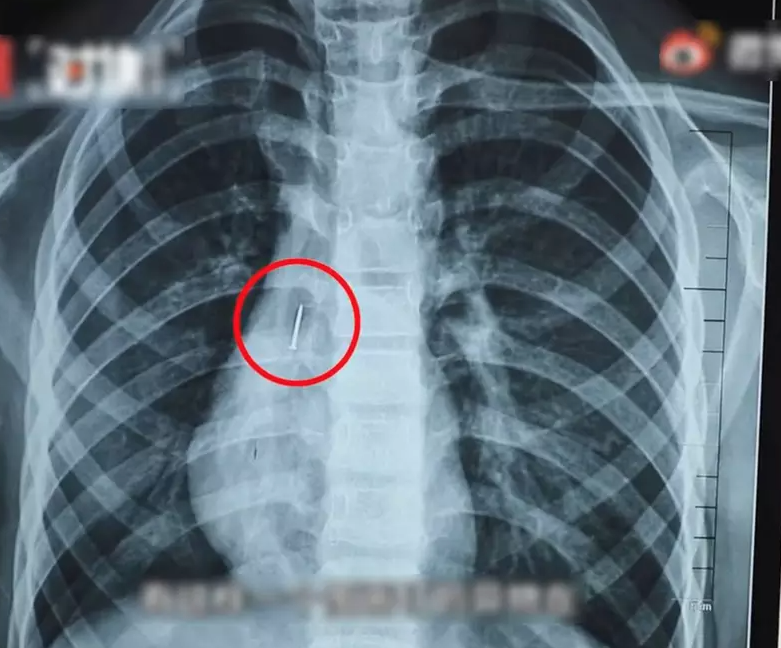 10歲童貪玩放3cm圖釘入口後邊行邊傾偈。