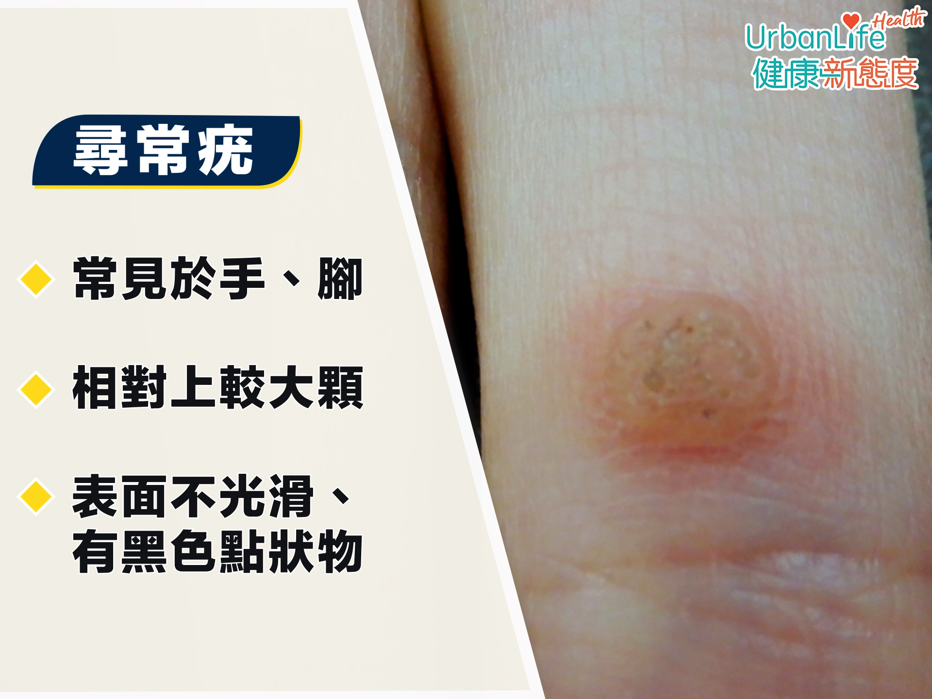 尋常疣一般較大顆。