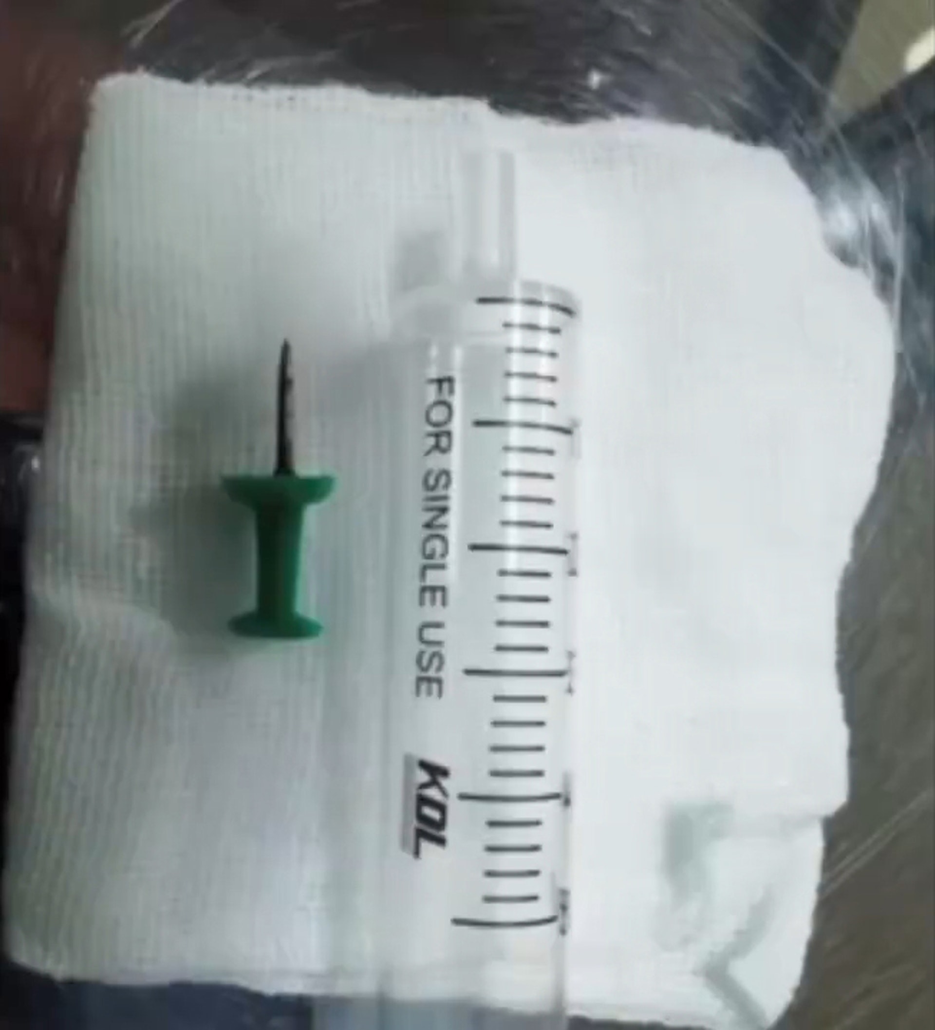 1小時手術後最終順利取出圖釘。