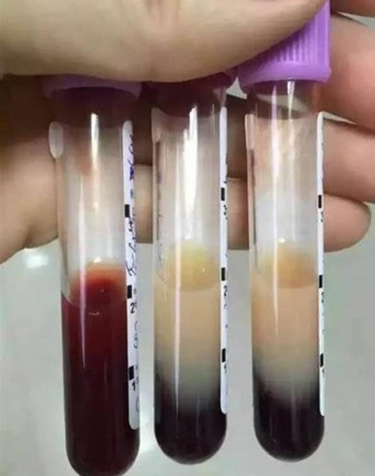 張婦人的靜脈血放置後甚至還出現了類似牛奶的顏色。