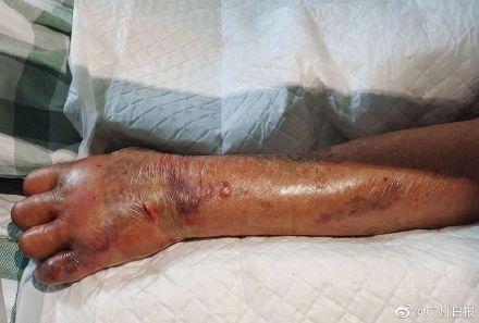 醫生診斷其感染創傷弧菌,導致手臂組織急速壞死,因情況嚴重,需緊急進行截肢手術。