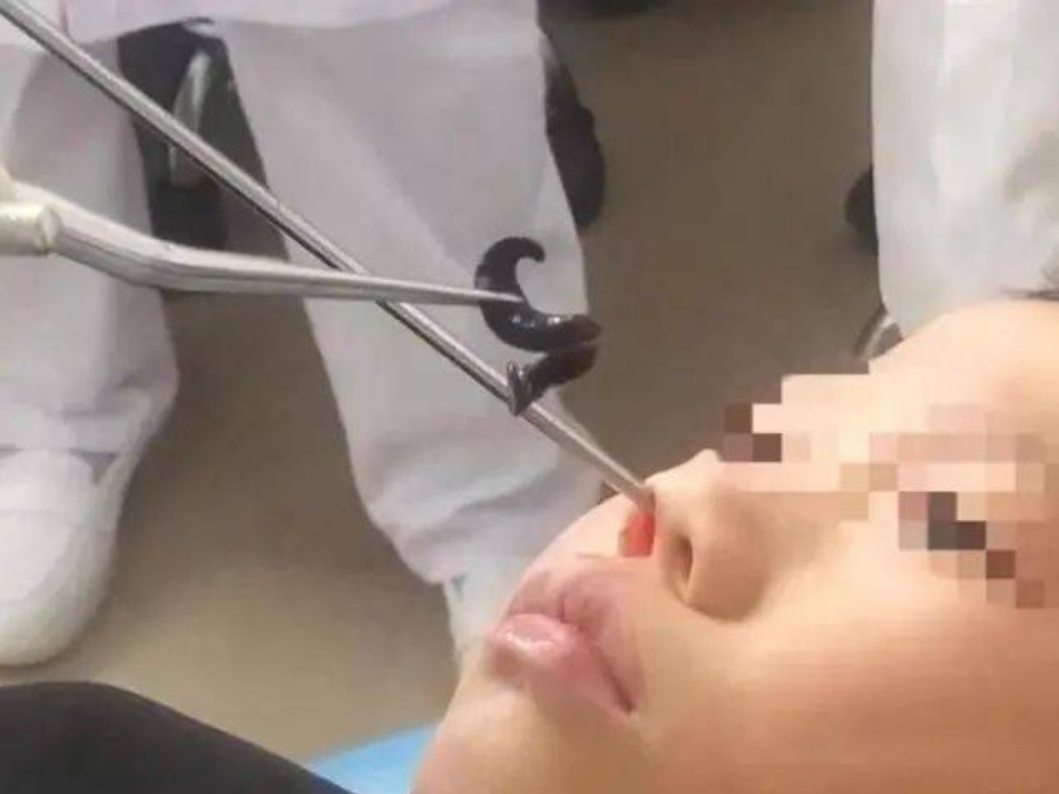 內地一名男童鼻塞半個月,求醫後夾出5cm吸血水蛭。
