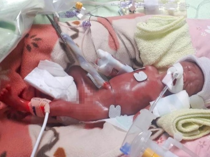 鄭太先自然產出23週6天,體重570克(約1.2磅)的大女。