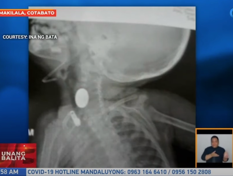 菲律賓2歲女童將3枚硬幣當糖食，硬幣卡喉險喪命。