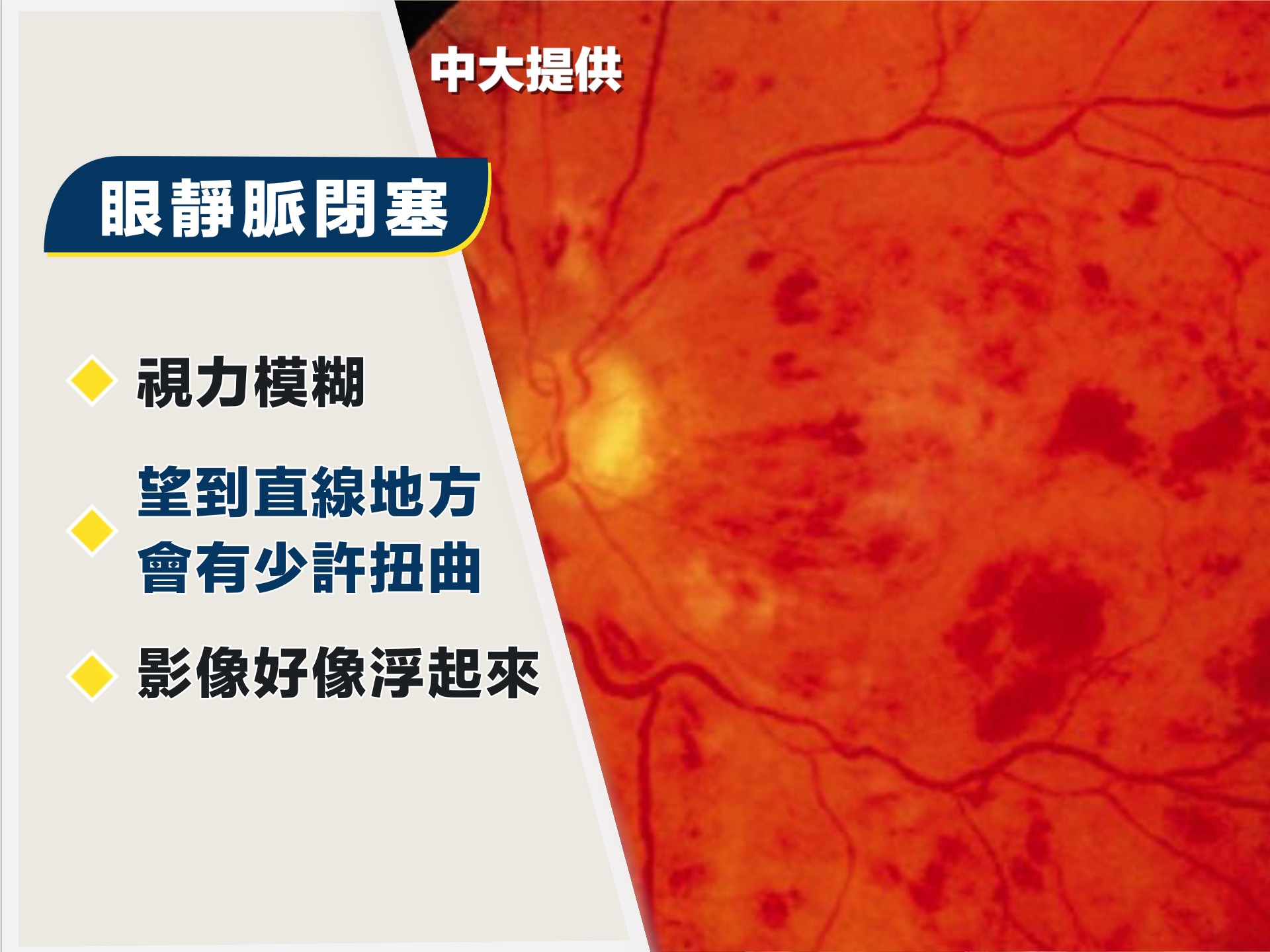至於靜脈中風患者,他們的症狀是3種眼中風類型中來得最慢。