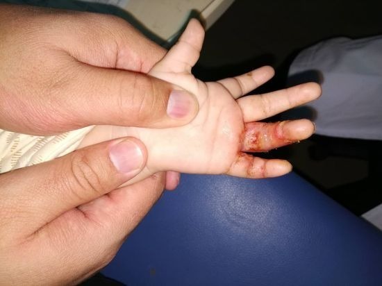 坊間偏方不要亂試!內地河南省一名男童燙傷,因傷口惡化緊急送院後,才揭發其嫲嫲竟然曾用老鼠油偏方為男童治理傷口。