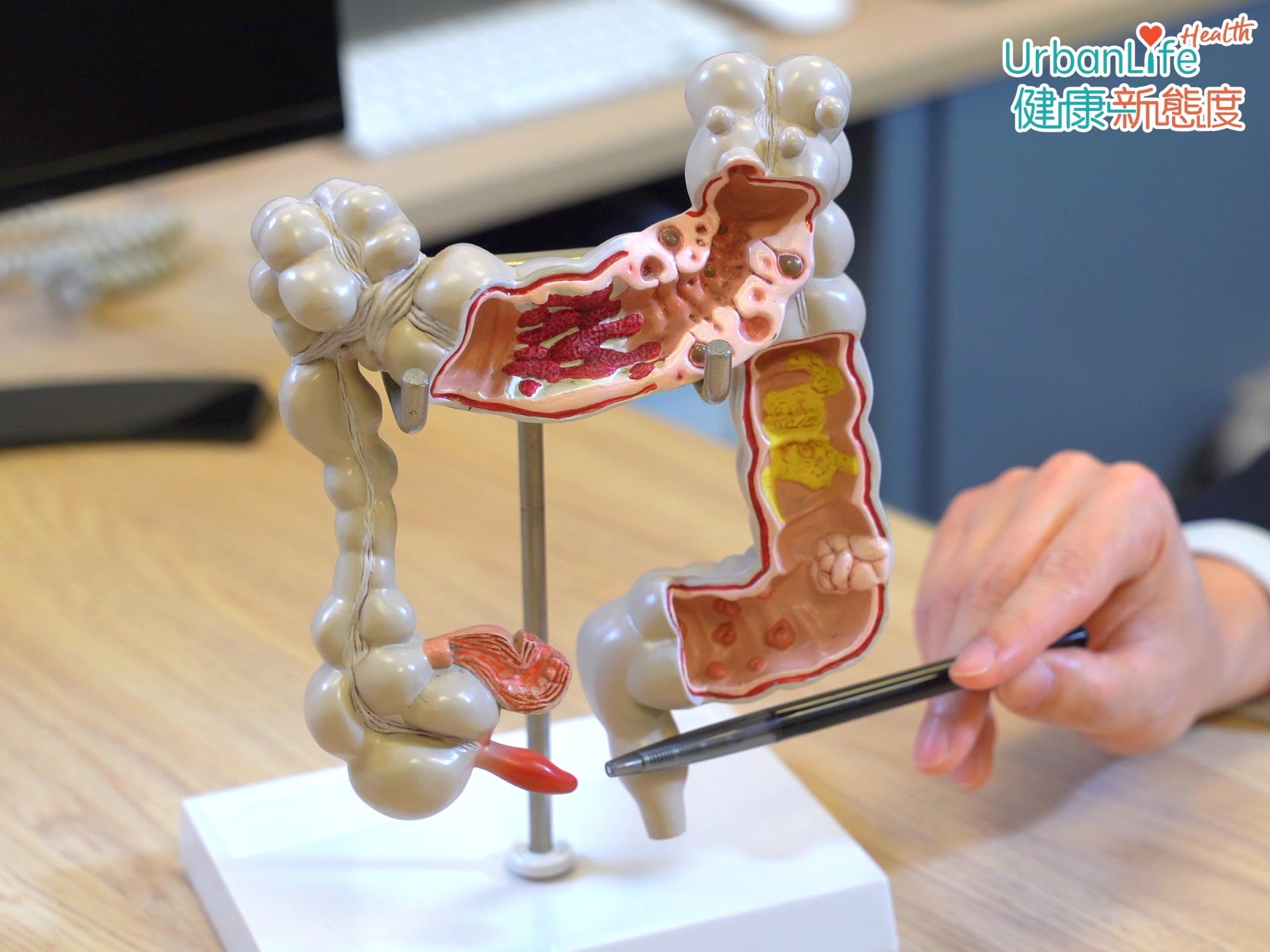 不要以為大腸癌只是老年人的專利!近年此症有年輕化趨勢,55歲以下患者不斷增加。