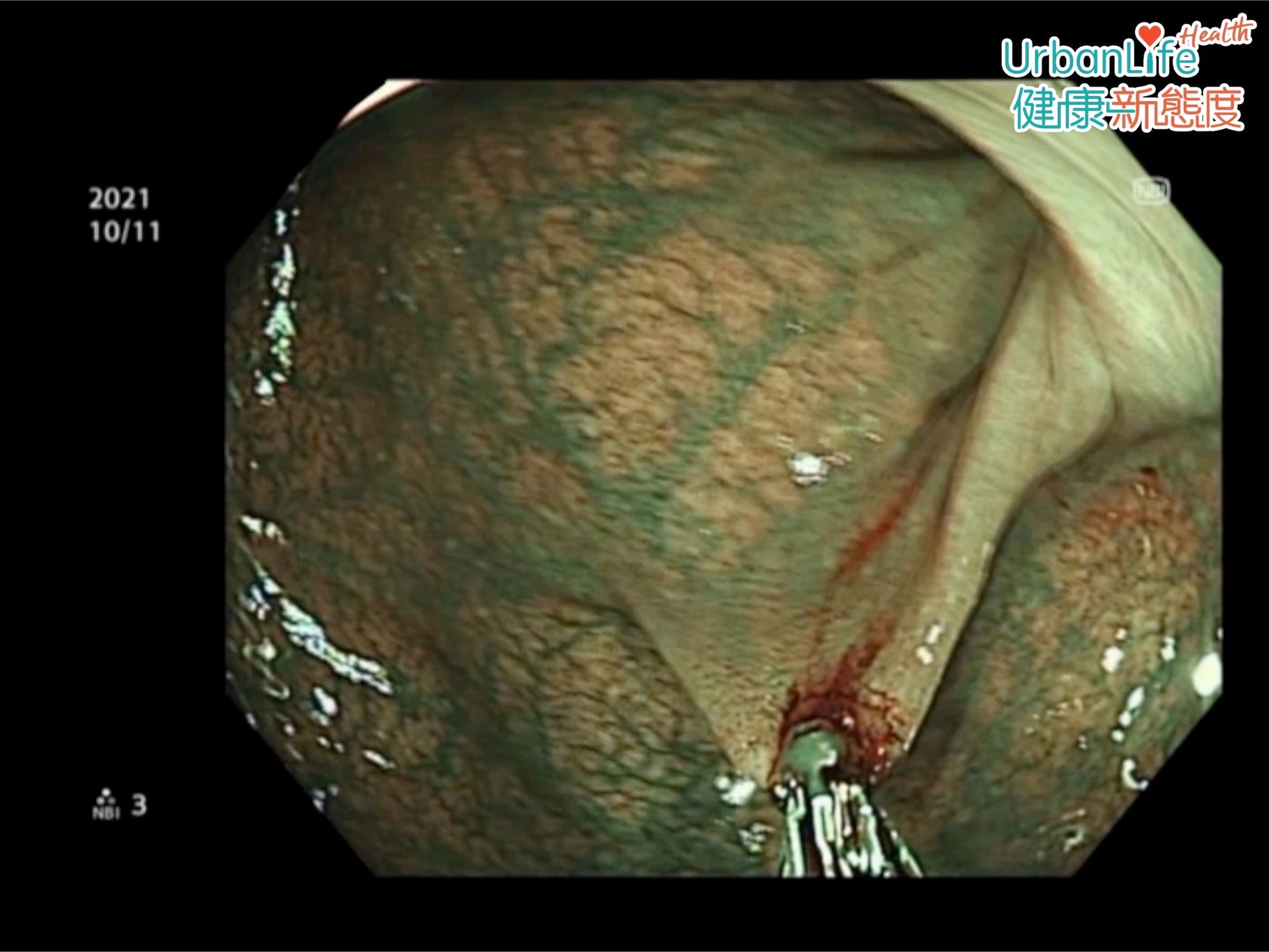 定期做大腸癌篩檢,檢查腸道內是否有瘜肉,如有瘜肉的話及早切除,就不會演變成腸癌。建議每5至10年進行腸鏡檢查。