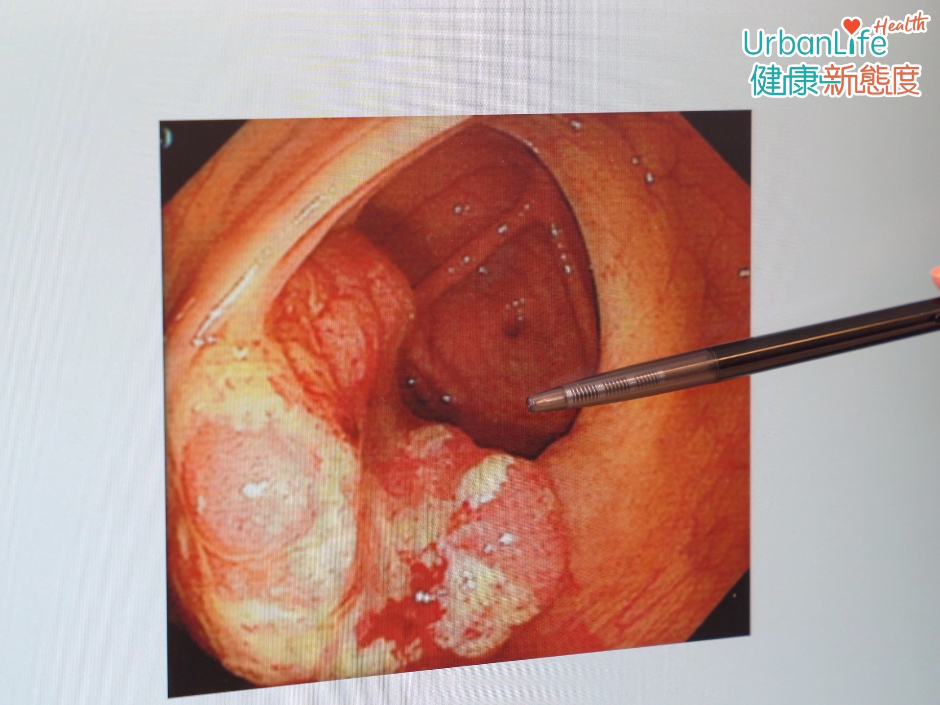 劉醫生提到,大腸癌可有很多症狀,亦可以沒有症狀。很多時早期或腫瘤較小,可能沒有明顯症狀。