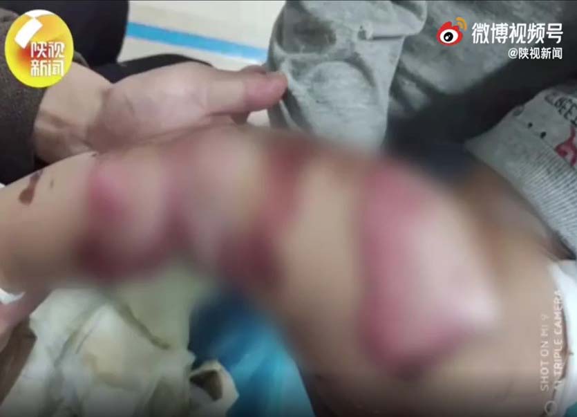 男童隨即被送院搶救,被診斷為混合二度燒傷。