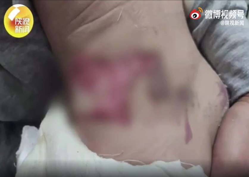 一名一歲男嬰無著尿片瞓電熱氈,瀨尿觸電下肢腰背嚴重燒傷。