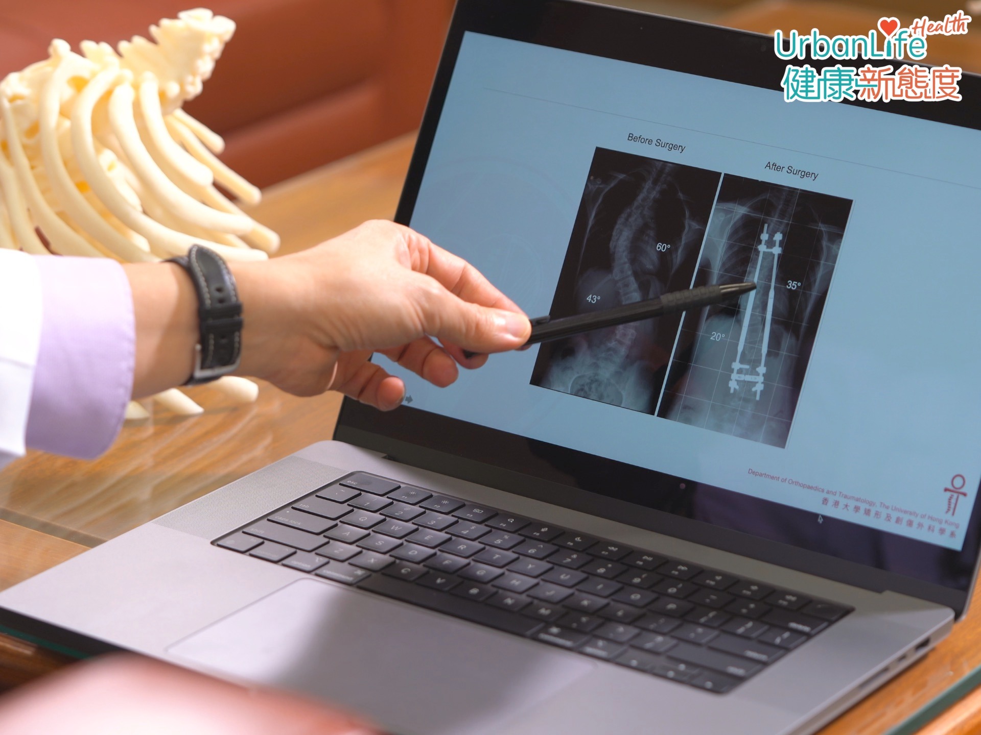 張教授指,針對10歲以下患者,現時會用一種遙控生長棒,進行非融合手術。