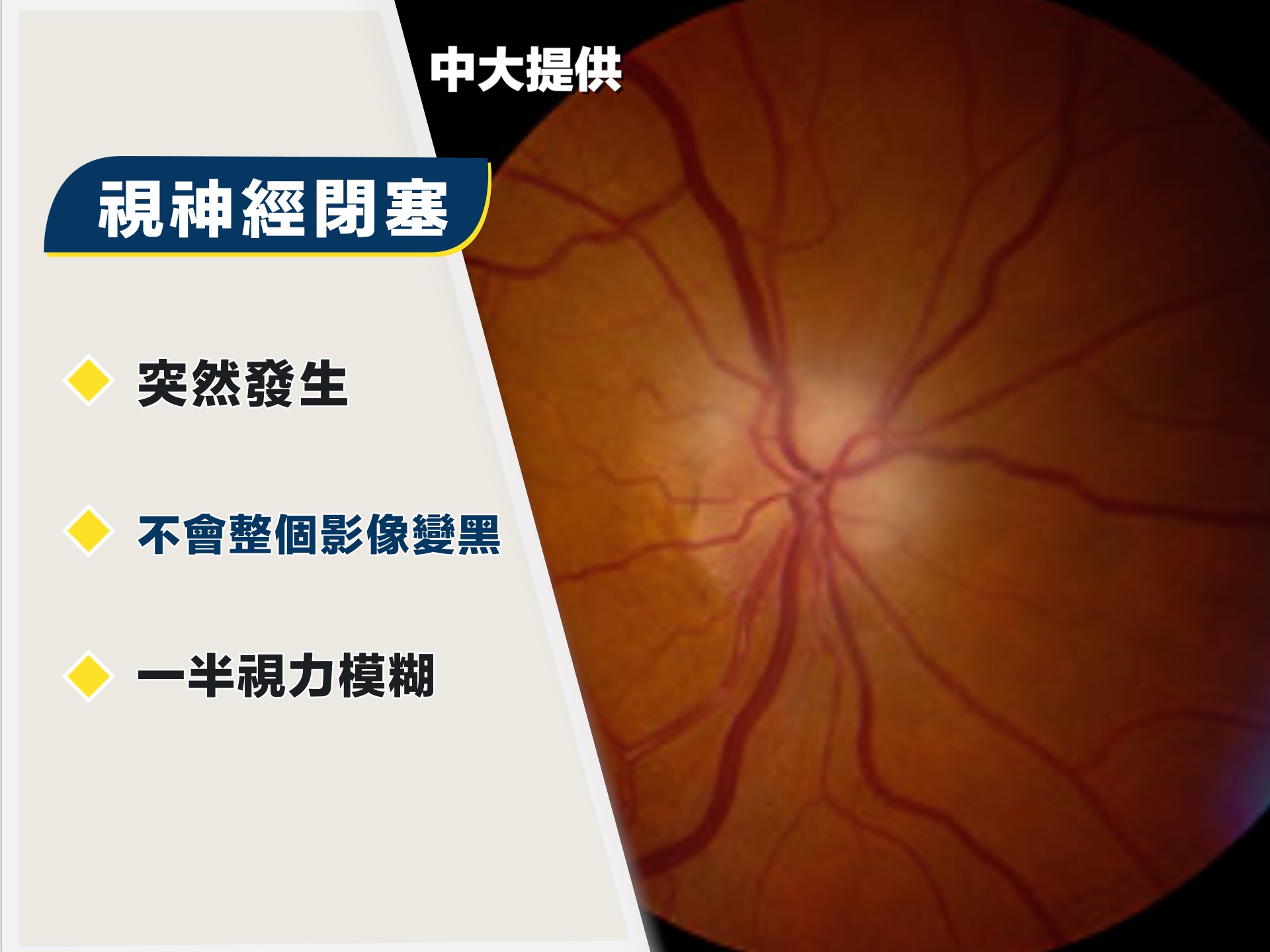 視神經中風的患者,一般會慢慢才察覺視力有異常。