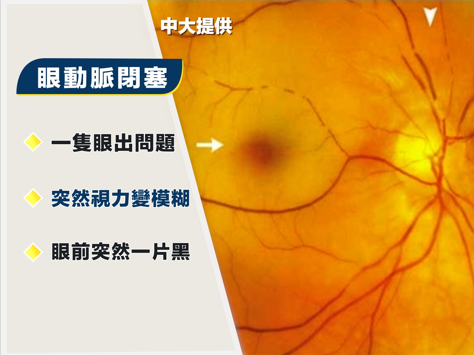 在徵狀方面,動脈閉塞的徵狀最為嚴重。