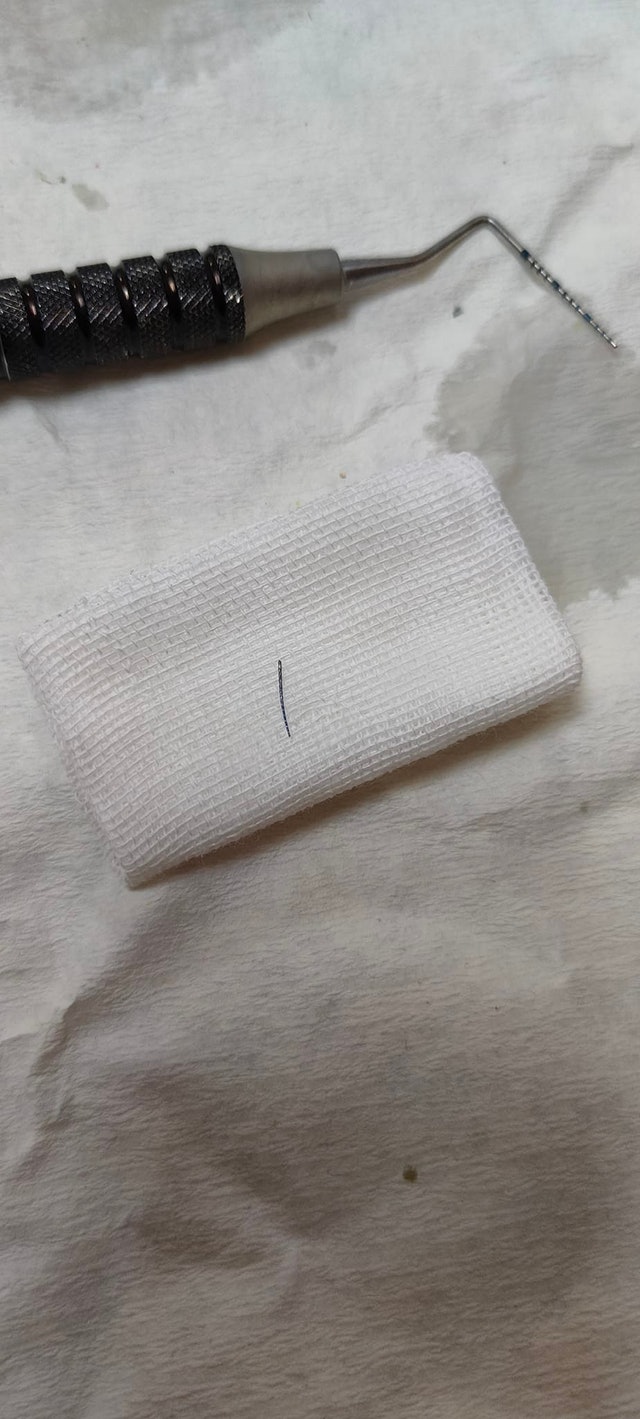 新牙醫發現,牙齒裏面有1根疑似根管探針的東西斷在裏面。