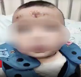 湖南長沙一名婆婆認為孫女久咳不癒是因體內有寒氣，並自行用銀戒指加蛋白為女嬰刮痧，導致孫女面部潰爛。