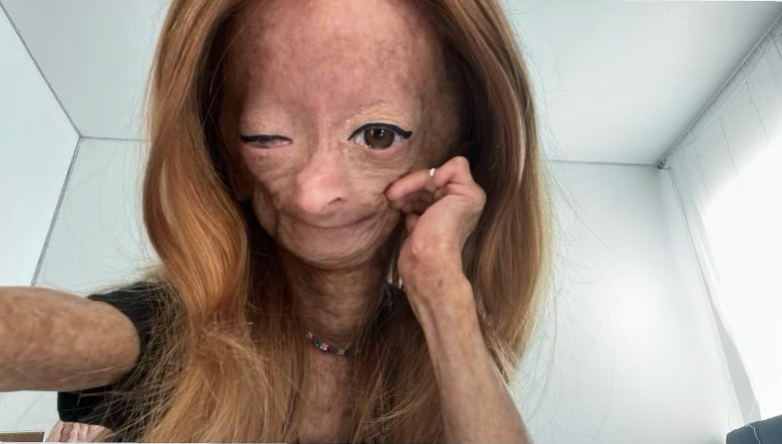 據其母親Natalia指,Adalia生前有時會說「希望和別人看起來一樣」,但她很快便會自我開解。