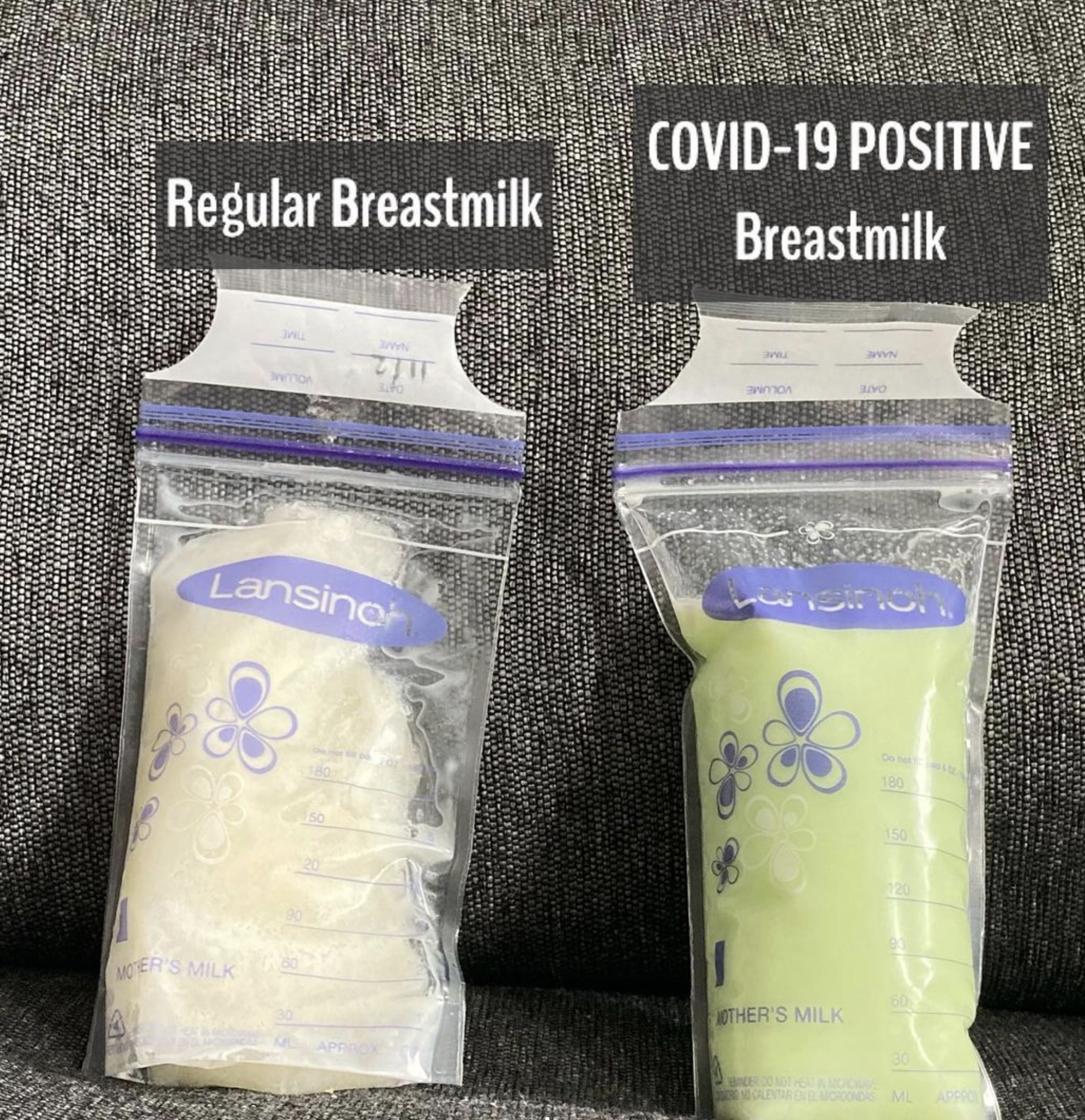 英國一名媽媽在餵哺母乳期間感染新冠肺炎,其後她的母乳顏色竟由奶白色變成螢光綠色。