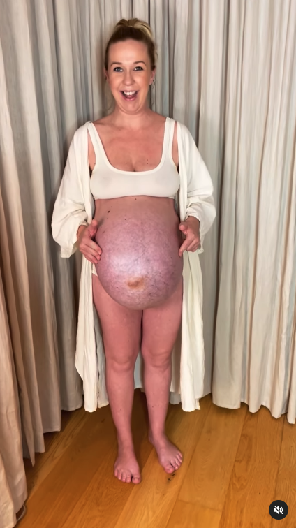 蜜雪拉剖腹產時，三胞胎約35週大，並於IG曬出懷孕35周又2天的影片，興奮地寫下：「明天，我們將成為7口之家」。