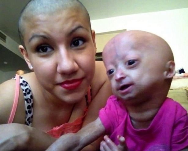 據外媒報導,來自美國德州的少女Adalia Rose, 自3個月大時,醫生便覺得她異於其他小朋友,肚皮緊繃、腹腔凹陷,最終便診斷患上罕見病早衰症。
