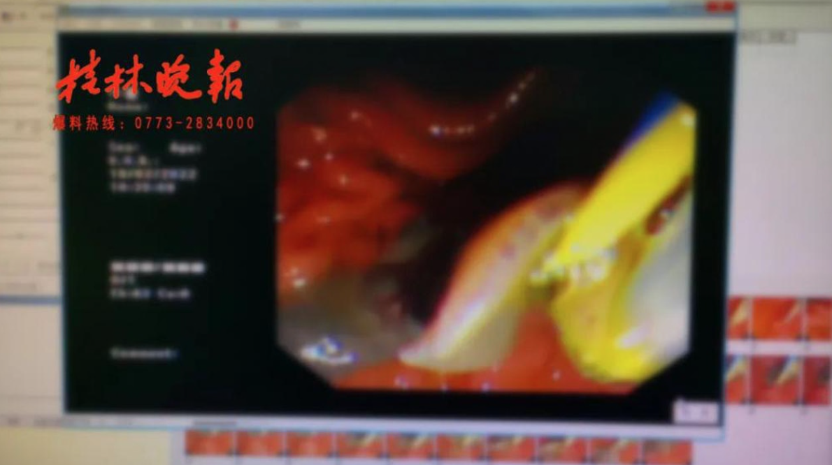 廣西有一名女子近日因上腹出現疼痛，噁心等症狀求醫前，檢查後才得知三分一之肝臟已被一隻體內寄生蟲吃掉。