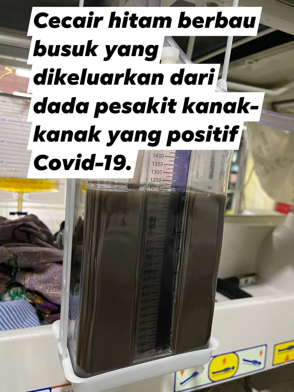 有馬來西亞醫生分享,一名兒童染疫後有嚴重肺積水,直言情況不常見或與1個成因有關。