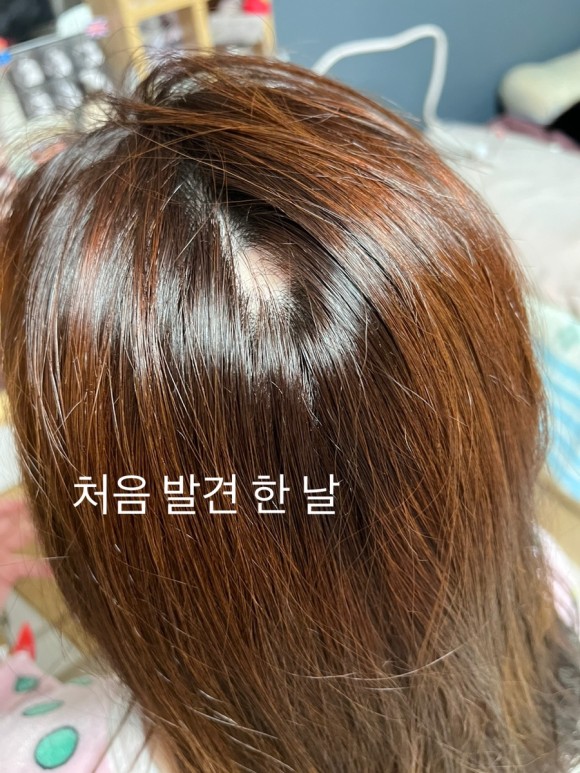 南韓一名20餘歲女子接種前兩劑疫苗都沒有出現特殊嚴重副作用,沒想到在第3劑莫德納疫苗一週後,便開始掉髮。