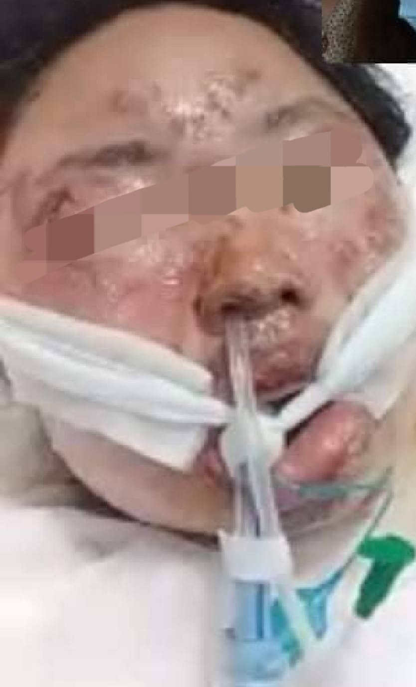 泰國一名女子使用酒精消毒全身時就發生了一宗意外,結果導致全身6成膚燒傷。