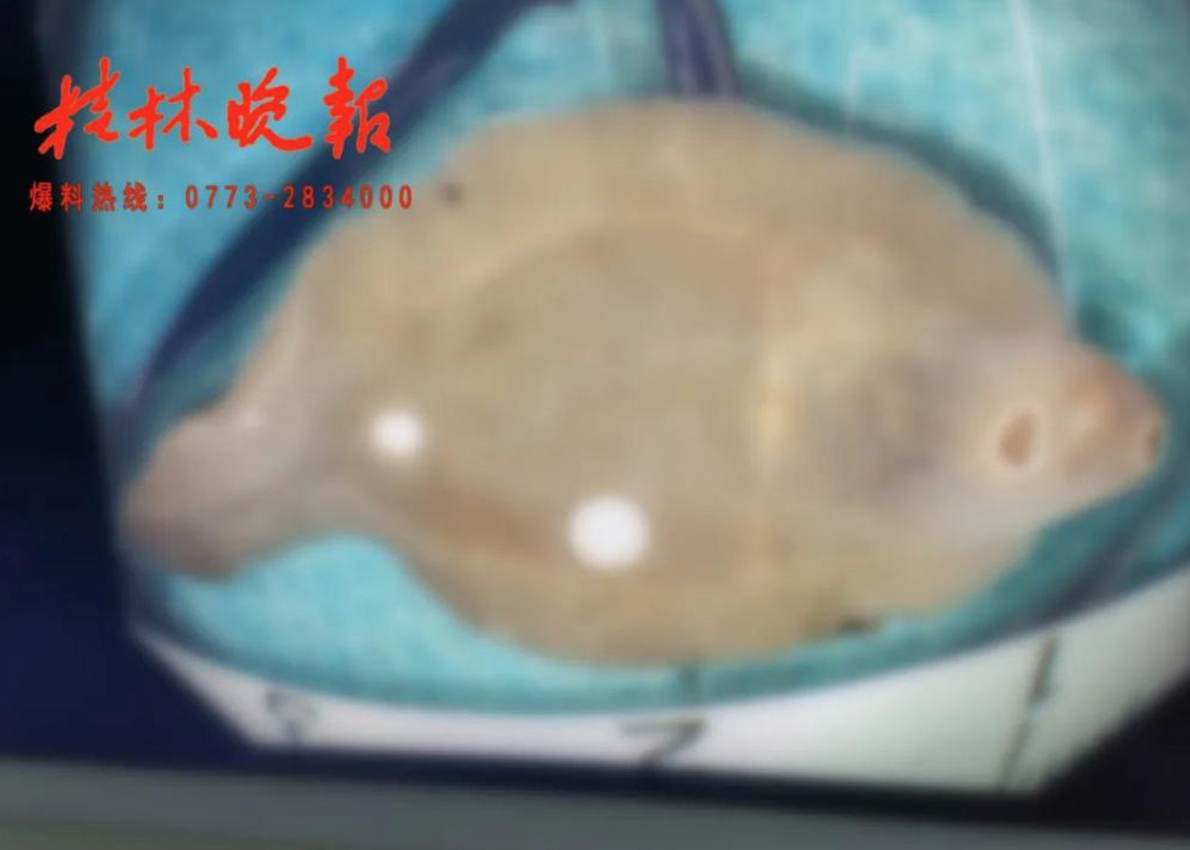 這寄生蟲不僅吃掉俸女士三分之一個肝臟，更導致其肝內外膽管受損嚴重。