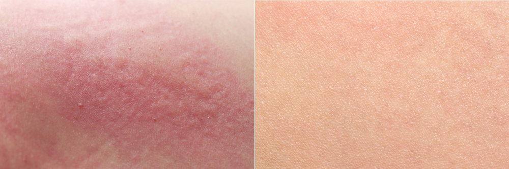 轉用Cetaphil PRO AD Derma潔膚露及潤膚霜兩星期的前後對比圖,由客戶真實分享