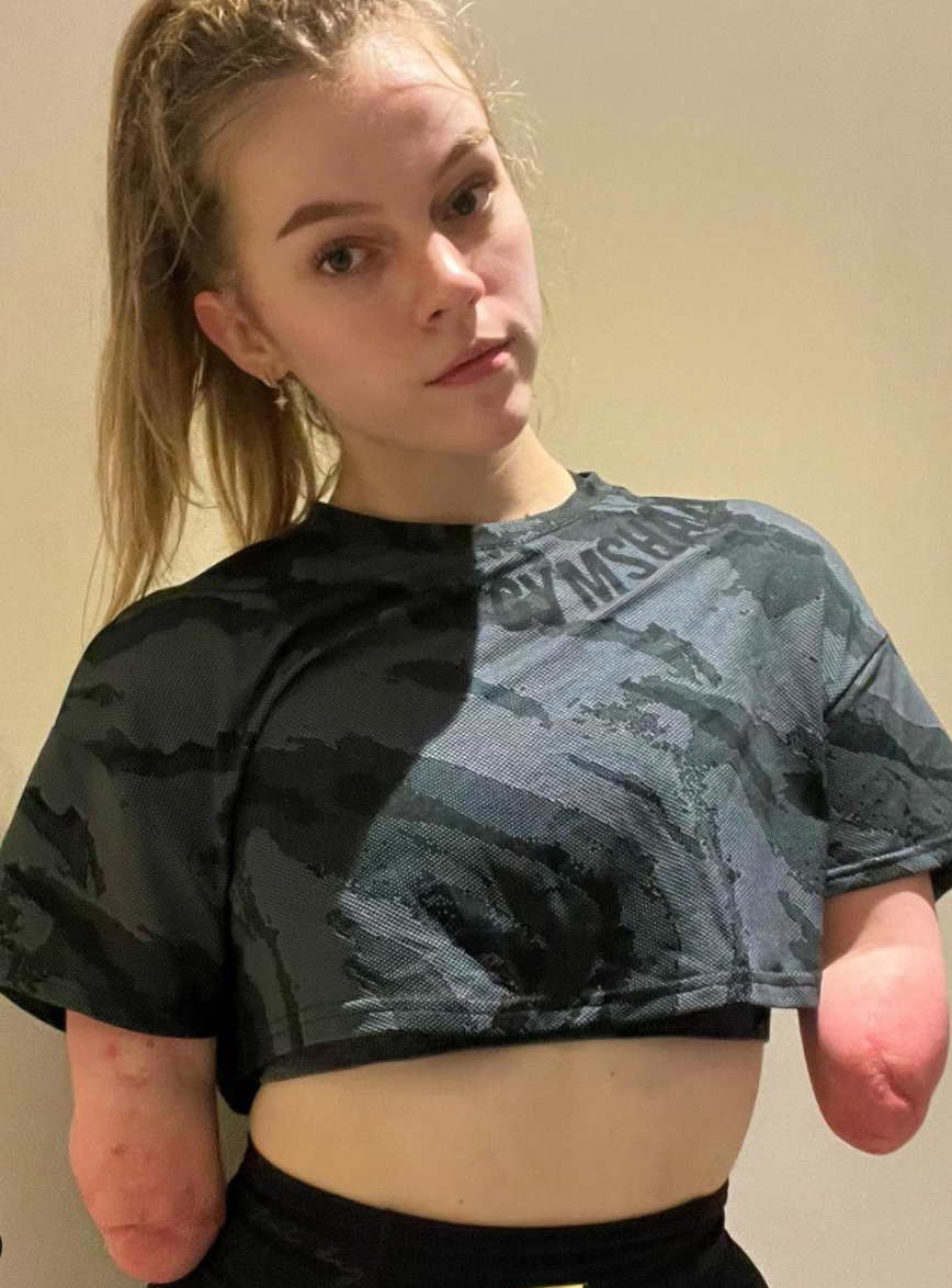 英國一名少女即使在年幼時因患重病須截四肢,她仍然沒有放棄。